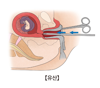 유산