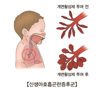 신생아호흡곤란증후군