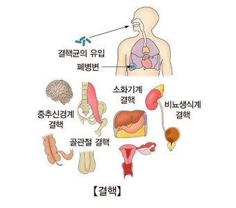 결핵