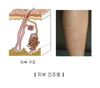 피부건조증