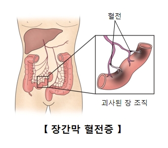 장간막 동맥 혈전증