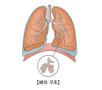 폐결핵