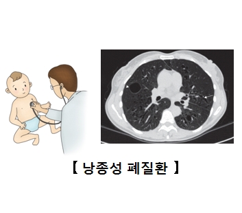 낭종성 폐질환