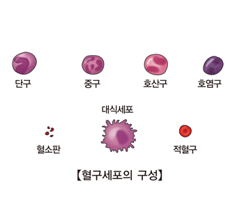 급성 림프모구성 백혈병