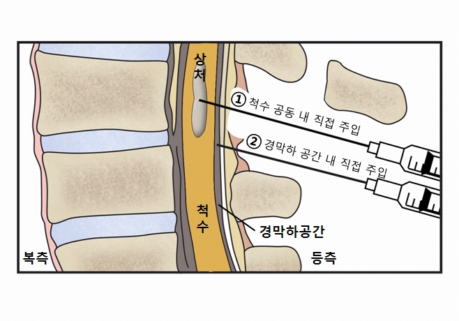 척수공동증