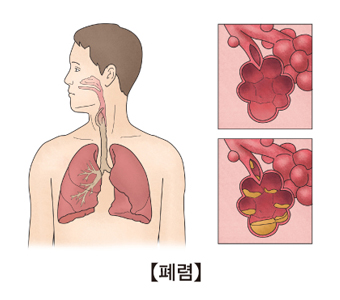 흡인성 폐렴