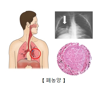 폐의 농양