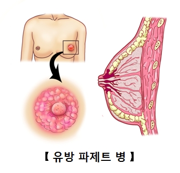 유방 파제트병