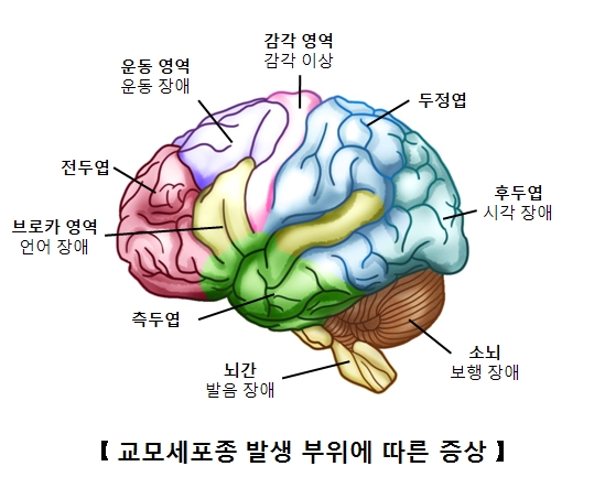 교모세포종