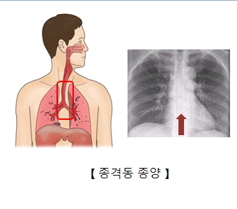 양성 종격동 종양