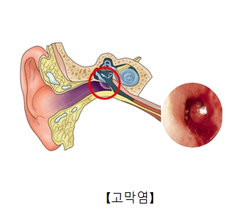 고막염