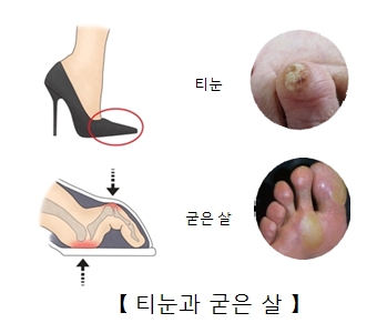 티눈 및 굳은 살