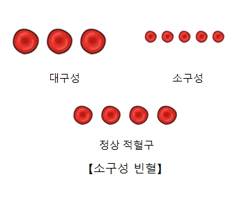 소구성 빈혈