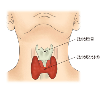 갑상선기능저하증