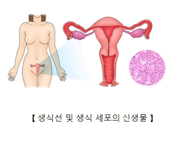 생식선 및 생식 세포의 신생물