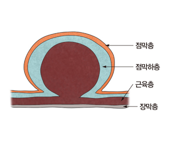 위장관 기질 종양