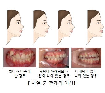 턱 머리뼈 바닥의 관계이상