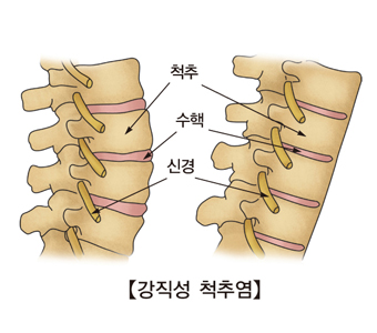 강직성 척추염