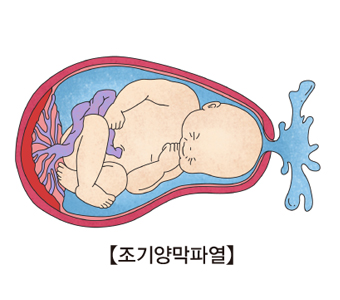 조기 양막 파열