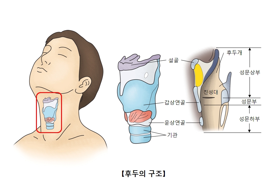 후두암