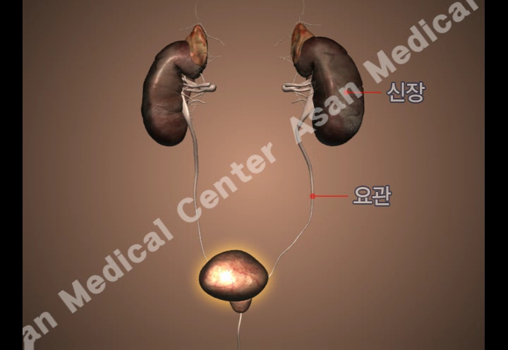 전이성 신장암