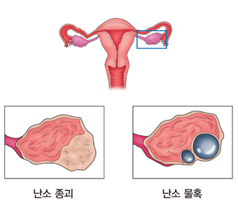 난소암