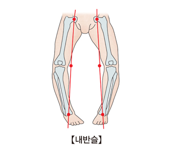 내반슬