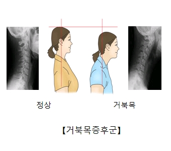 거북목증후군