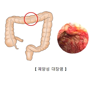 궤양성 대장염