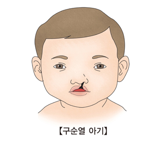 구순열