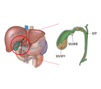 담낭용종