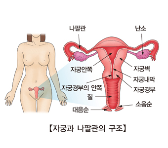 여성 불임