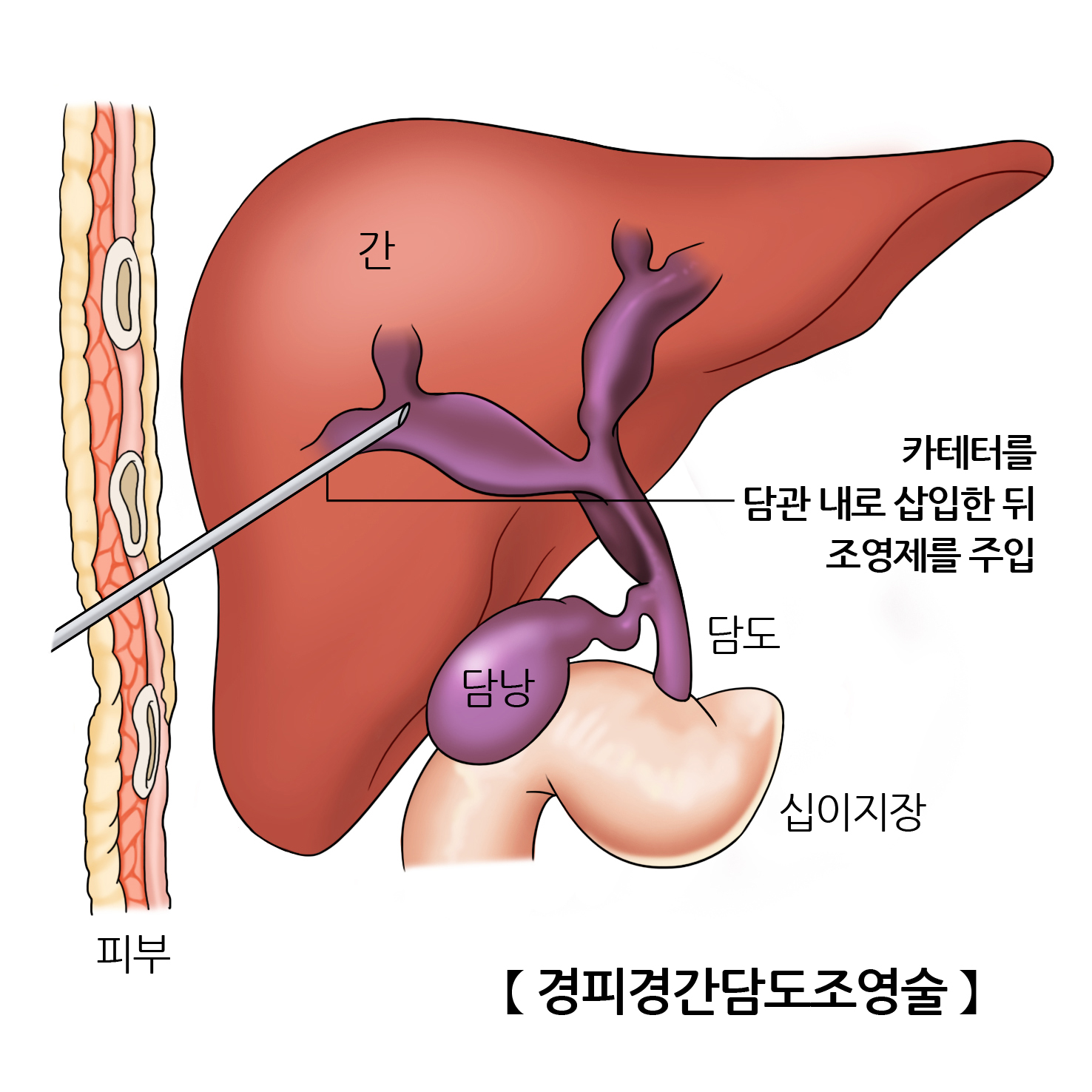 시술 모식도