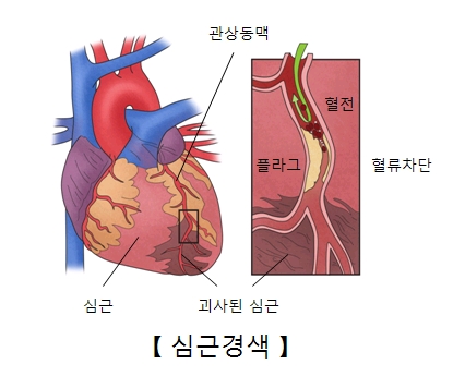 심근경색