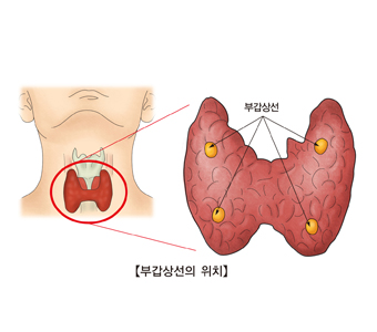 부갑상선