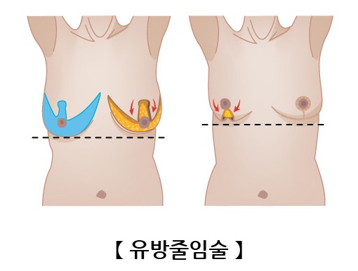 유방줄임술