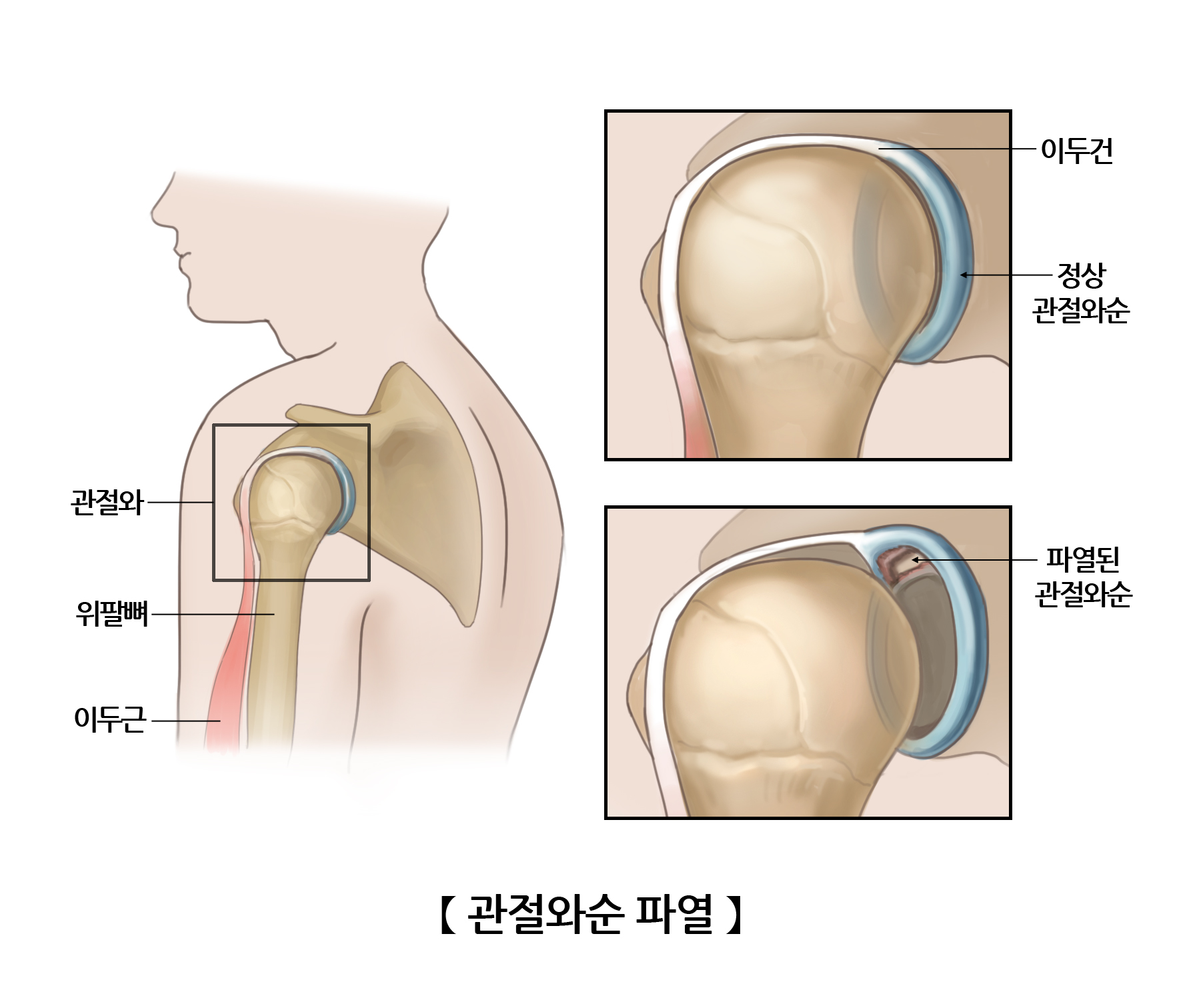 관절와순 이미지